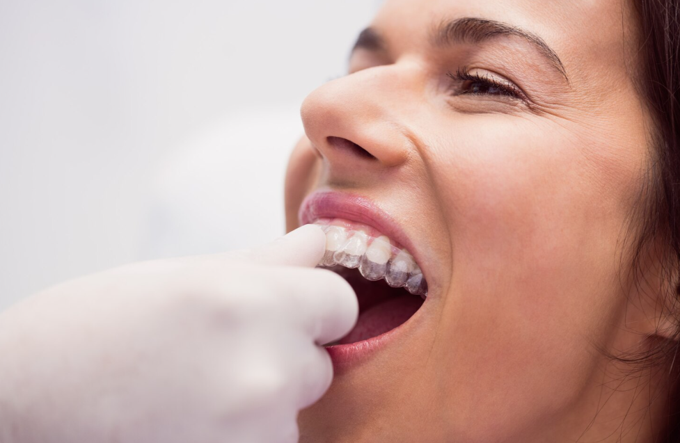 Alinhadores Invisíveis (Invisalign) em Blumenau: Discrição e Tecnologia para o Seu Sorriso